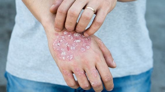 atopic dermatitis