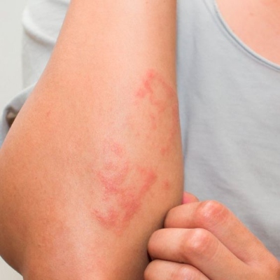 eczema on arms