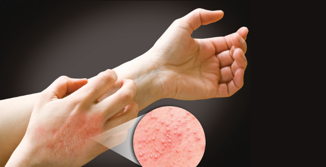 manage allergy symptoms like contact dermatitis