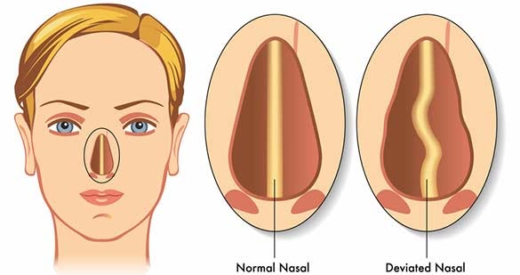 Sinusitis Symptoms, Risk Factors, Diagnosis And Treatment | Narayana Health
