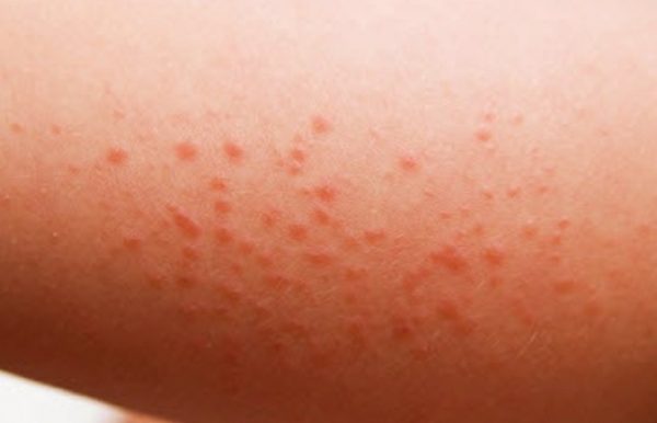 Poison Ivy Allergy New York Allergy And Sinus Centers