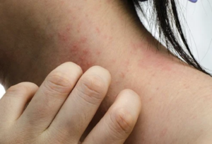 metal allergy rash