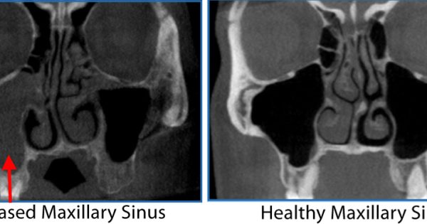 3 D Sinus Imaging Ct Scan Of The Sinuses Ny Allergy Sinus Centers