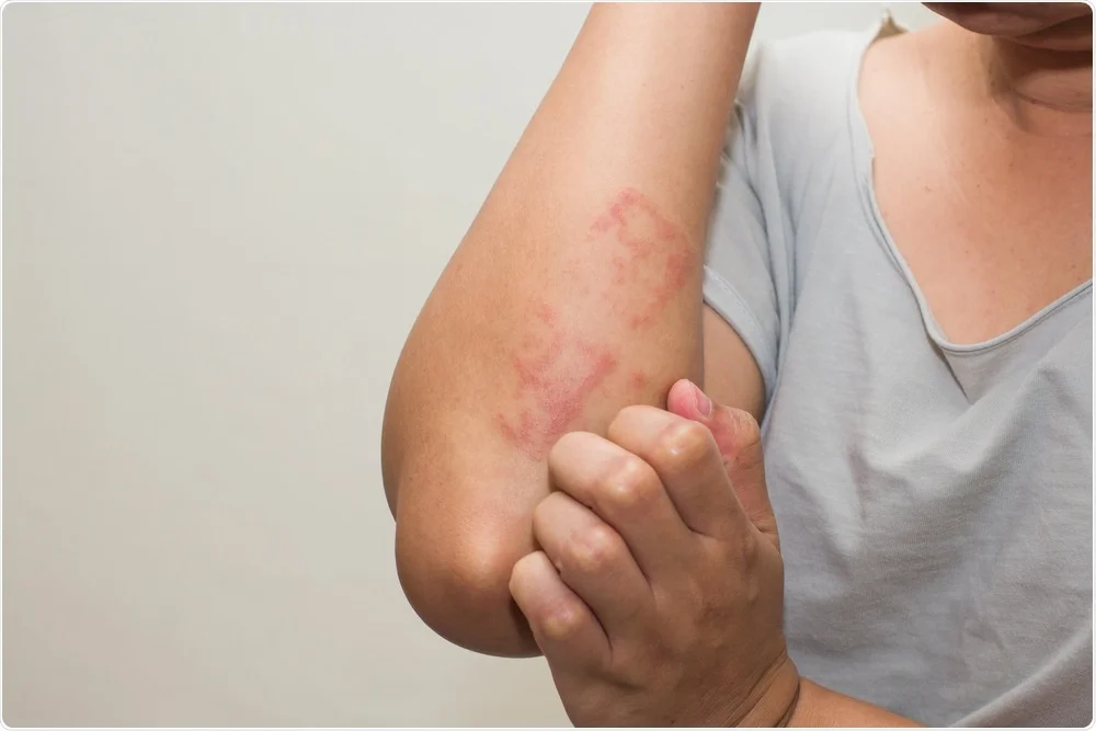 Hives on arm